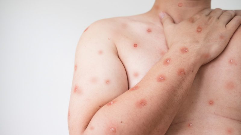 Pessoa com diversas erupções cutâneas causadas pela Mpox