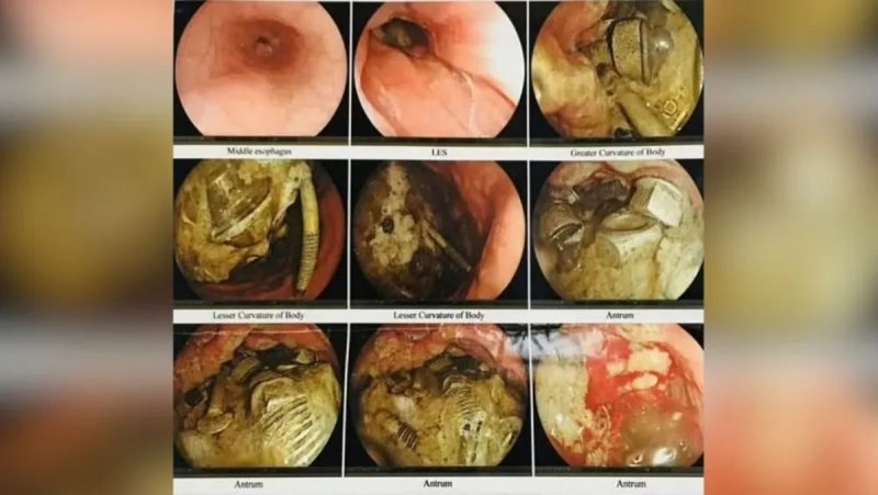 Objetos de metal estavam bloqueando a saída do estômago do paciente