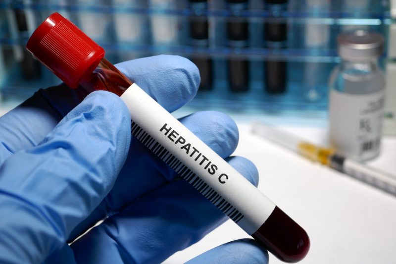 Amostra de sangue com Hepatite C